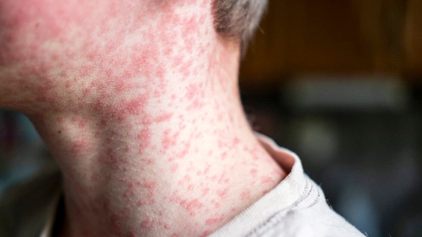 HPA’s latest update shows the Maldives has recorded 144 measles cases this year, including 23 new infections reported in the past week. | Photo: Getty Images